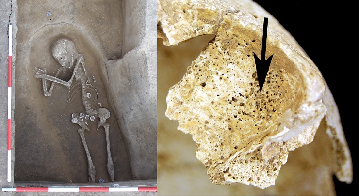 Manifestations of anaemia found on the skeleton of a young woman from a grave of the Stroked Pottery culture (at the Kolín site). The top of her left orbital is perforated with tiny pinholes with their maximum degree of concentration located in the upper left quadrant.